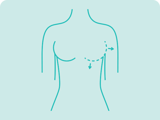cirurgia plastica mamoplastia aumento protese mamaria