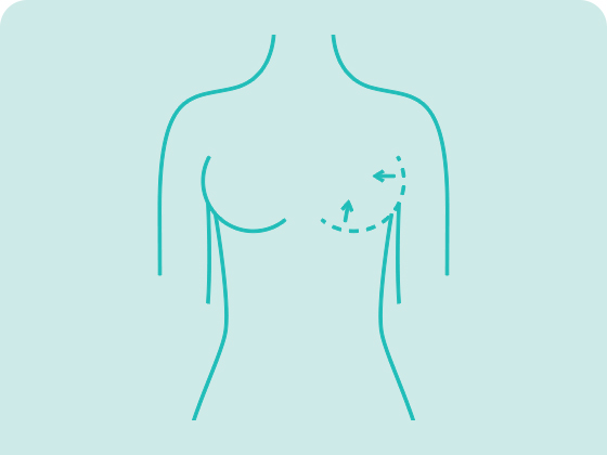 cirurgia plastica mamoplastia redutora mastopexia