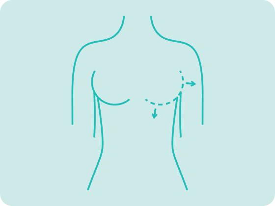 cirurgia plastica mamoplastia aumento protese mamaria